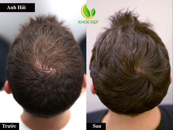 Sản phẩm giúp tóc mọc nhanh gấp 3 lần (*) và không gây hại cho da đầu